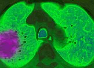 Cancer Deaths 45% Higher in Northern Ireland’s Deprived Areas cancer-deaths-45-higher-in-northern-relands-deprived-areas